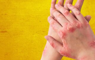 Le psoriasis - Causes, conséquences et traitements